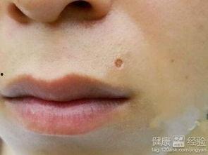 点痣可以吃瓜嘛,美味瓜果可否享用？揭秘术后饮食禁忌